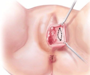 labiaplasty-de-epithelialization
