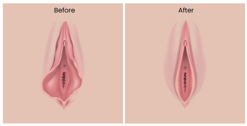 labiaplasty-procedure
